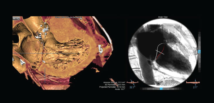 Pie Medical Imaging Upgrades 3mensio Structural Heart Planning