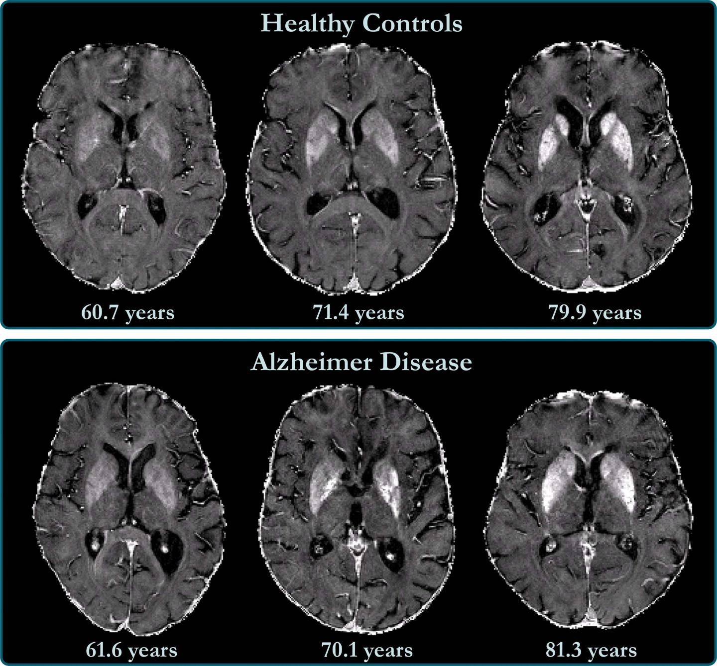 Brain Iron Accumulation Linked Decline Alzheimer's Patients Imaging Technology News