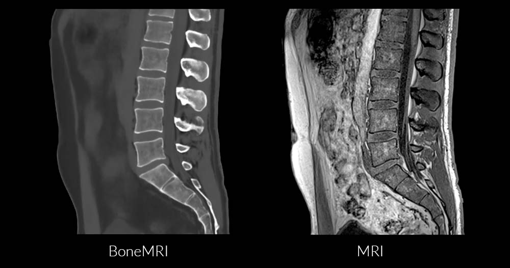 Magnetic Resonance Imaging (MRI): Lumbar Spine (for Parents