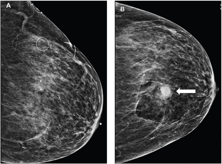 Comparison of the breast mass with the craniocaudal (CC) and