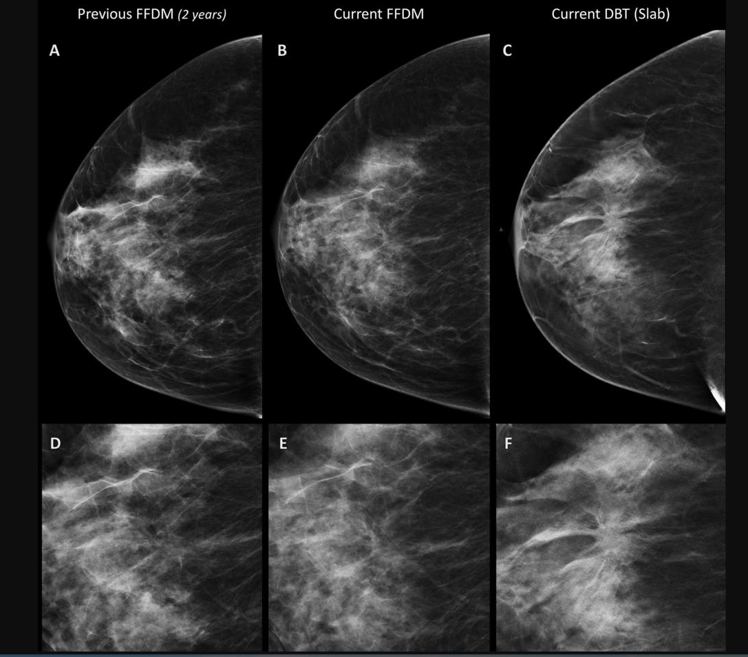 Study Examines Causes of Death in U.S. Breast Cancer Survivors