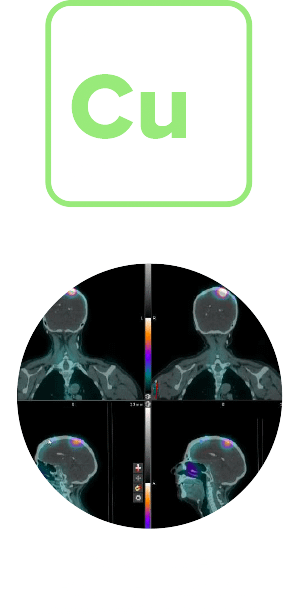 First Participant Treated Using NorthStar Medical Radioisotopes' Electron  Accelerator-produced Copper-67 (Cu-67) in Clarity Pharmaceuticals' Phase  I/IIa Theranostic Clinical Trial Investigating Cu-67 SARTATE for Treatment  of Neuroblastoma