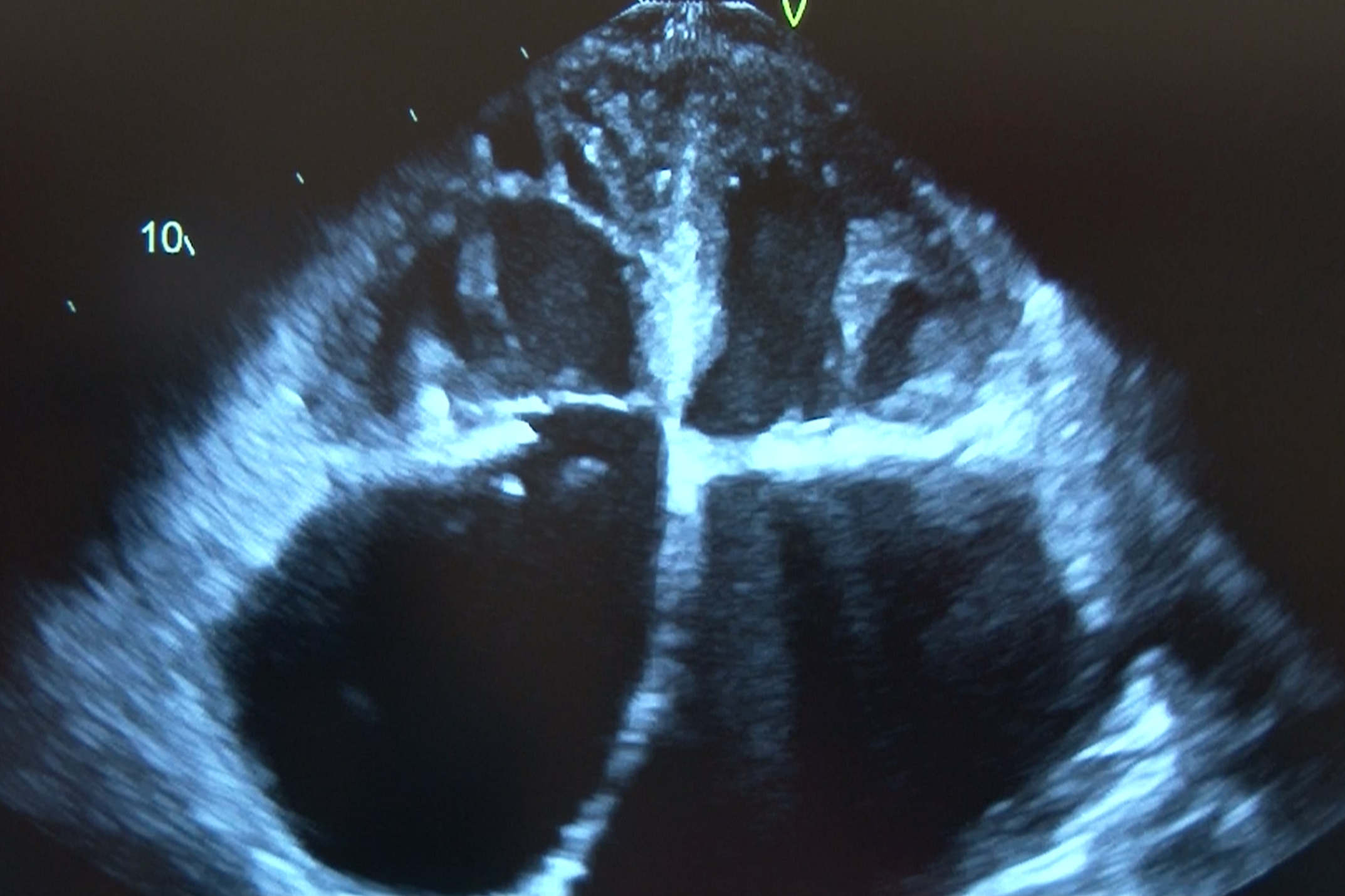 Echocardiographic Assessment of LV Diastolic Function Webinar 