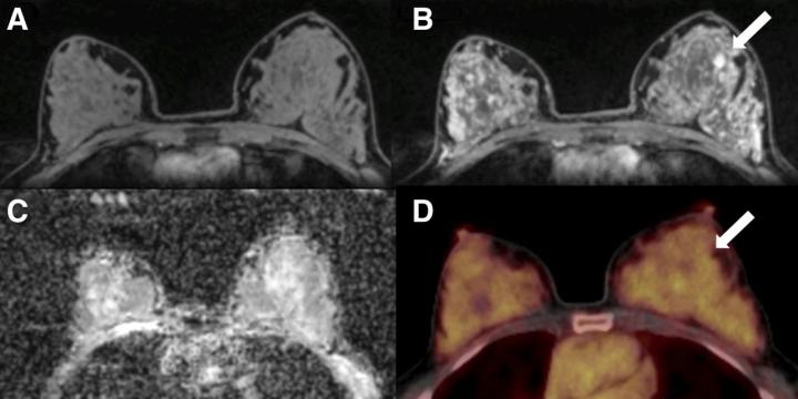 Imaging in Breast Cancer