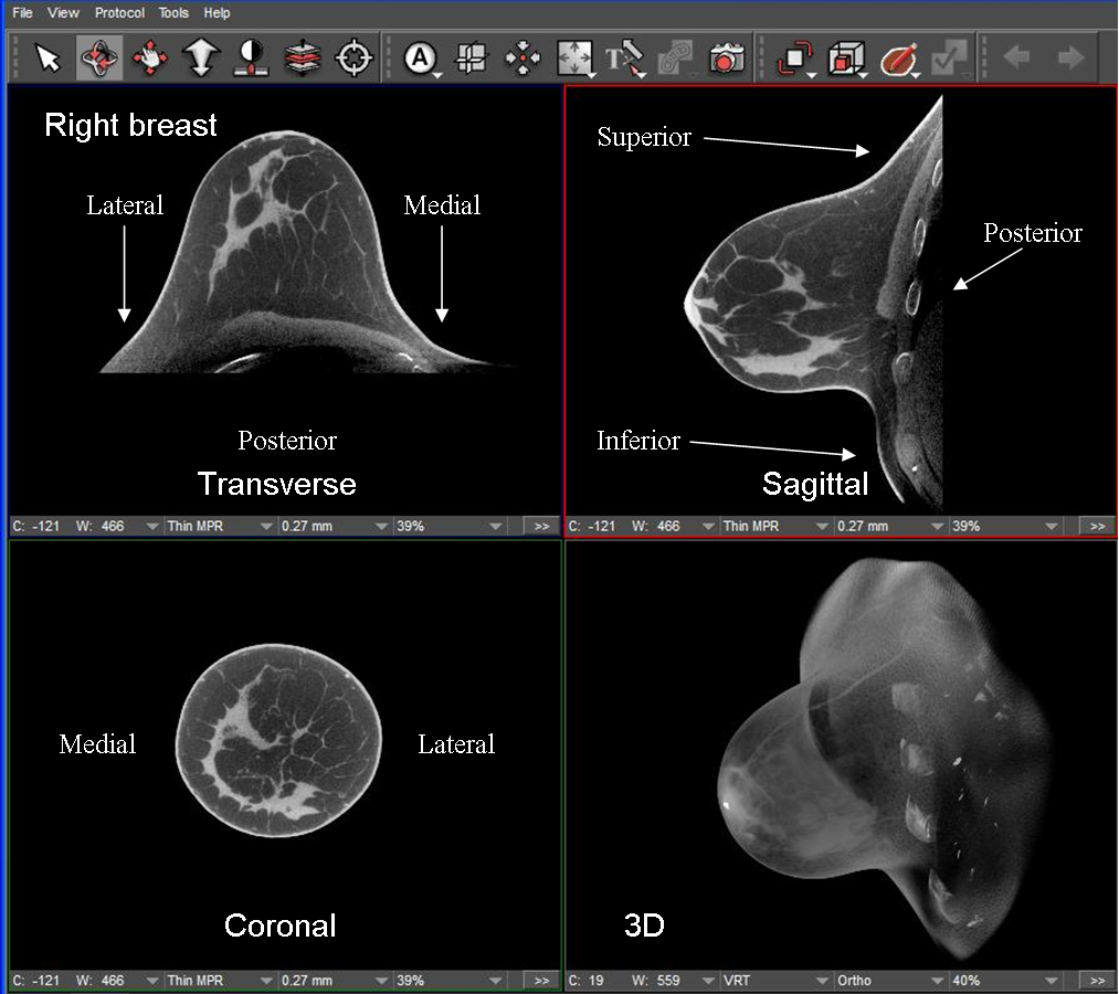 Medial-Lateral View of the Breast - Trial Exhibits Inc.