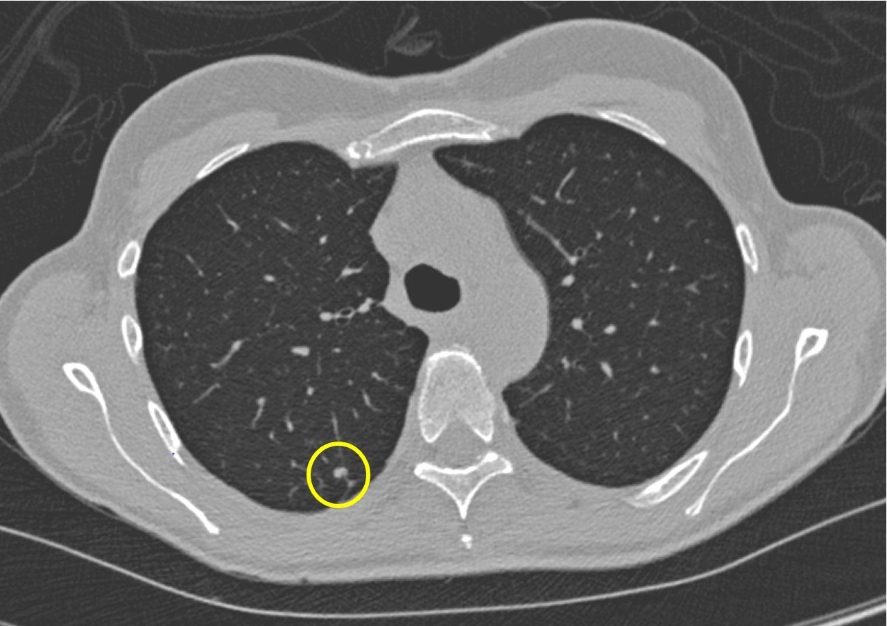 Lung Cancer Death Decline Associated With Screening, Earlier Diagnosis and Surgery Imaging Technology