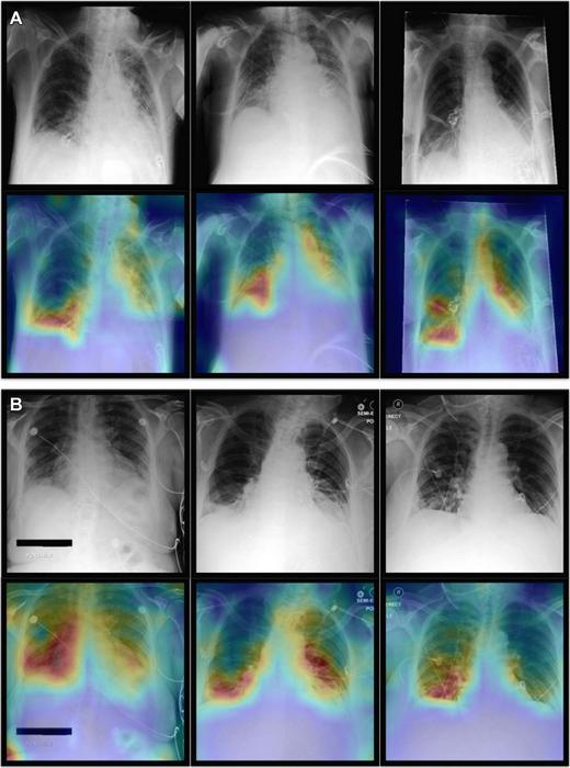 AI Could Detect Cancer in Chest X-Rays - 360PEO Inc.