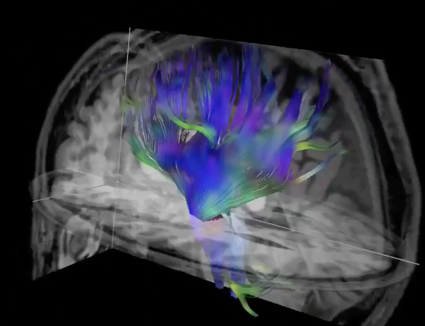 A novel repetitive head impact exposure measurement tool