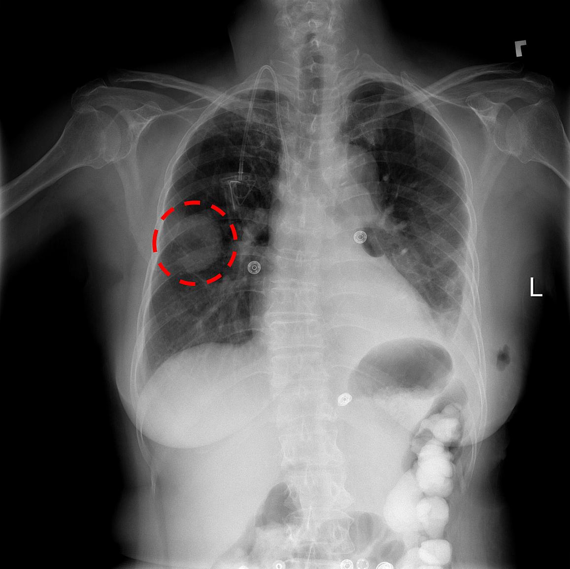 NIH Clinical Center Releases 100,000-Plus Chest X-ray Datasets to 