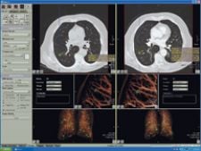 Is Lung Cancer better detected using an X-Ray or CT Scan?