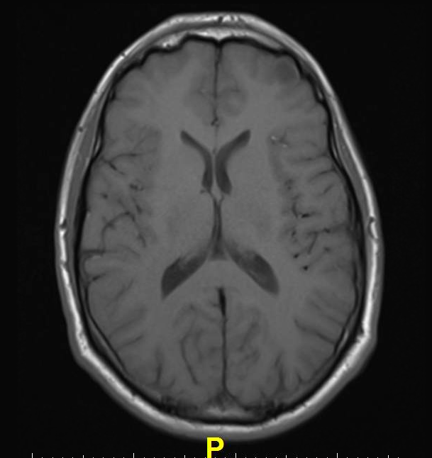 mri scan brain normal