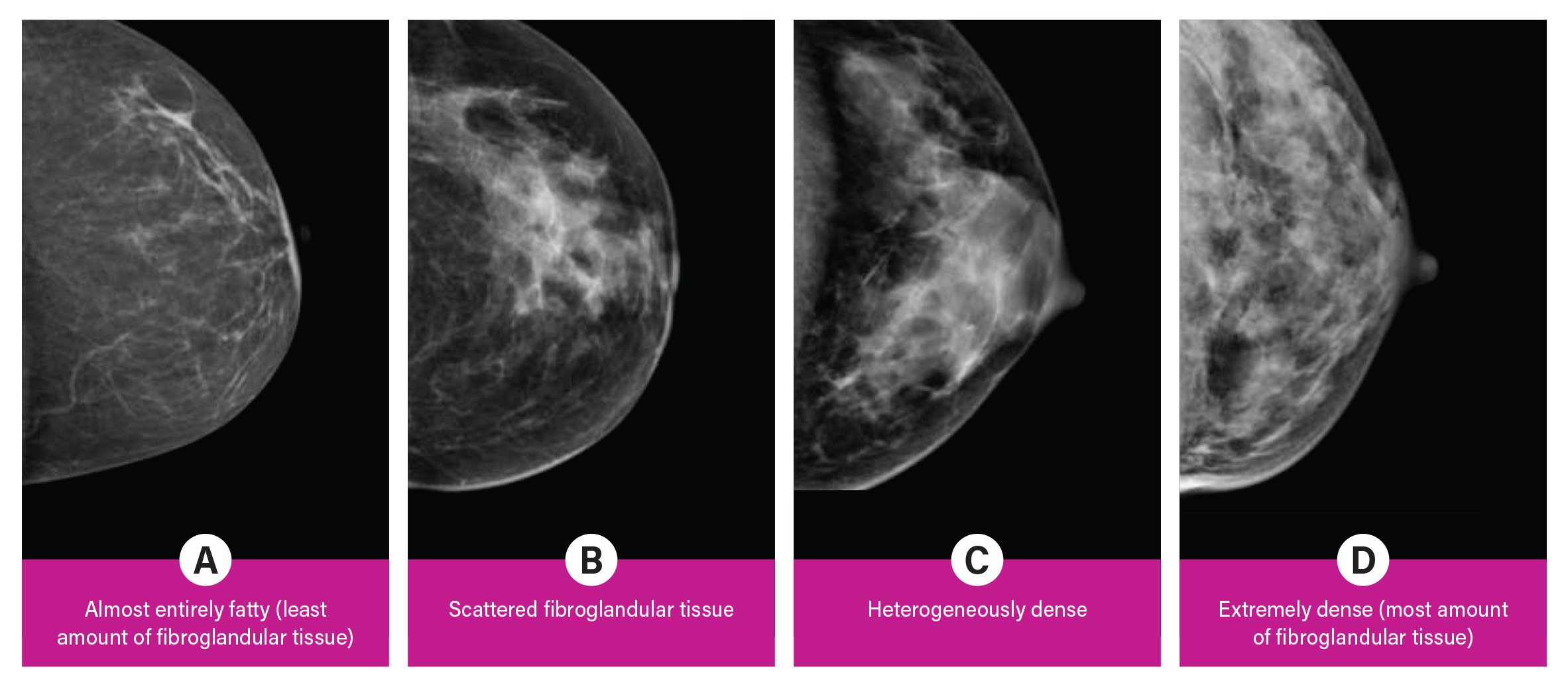 Breast anatomy: fibroglandular and fat tissues, which have distinct