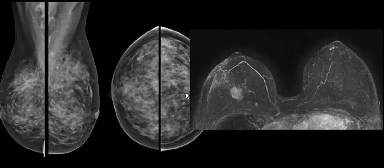 Accessory breast tissue, Radiology Reference Article