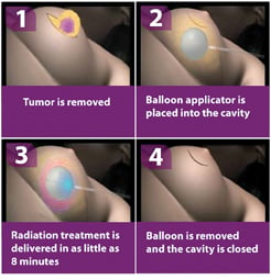 Intraoperative Radiation Therapy for Early Stage Breast Cancer