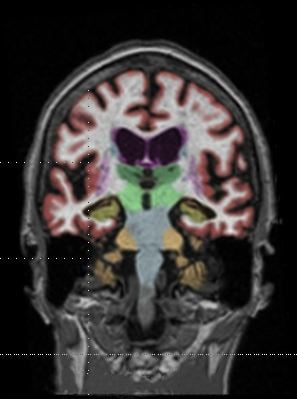 normal brain mri with contrast
