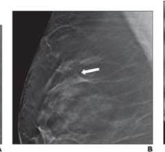 49-Year-Old Woman Presenting for Screening Mammography, Revealing Right Breast Architectural Distortion: (A) Right craniocaudal, (B) mediolateral oblique, (C) spot compression tomosynthesis images show architectural distortion in right breast at 12 o’clock position (arrows). No sonographic correlate identified. Tomosynthesis-guided needle biopsy yielded radial scar—not upgraded at surgery.
