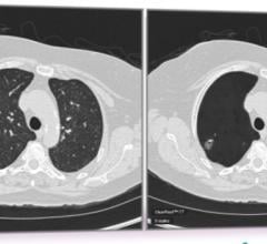 Researchers Use Radiomics to Overcome False Positives in Lung Cancer CT Screening