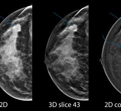 Hologic, RSNA 2015, breast tomosynthesis, breast biopsy systems