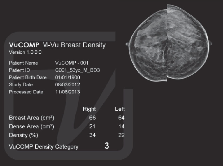 3D mammography detects 34 percent more breast cancers 