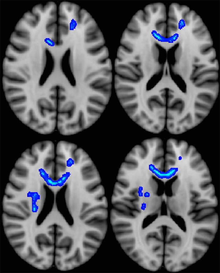 Imaging Predicts Long-term Brain Injury Effects in ...