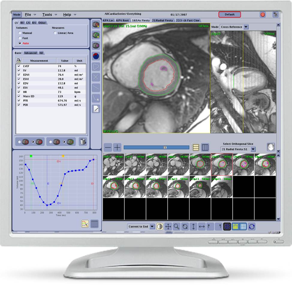 Ge Healthcare Introduces New Cardiac Mri Analysis Software Imaging Technology News