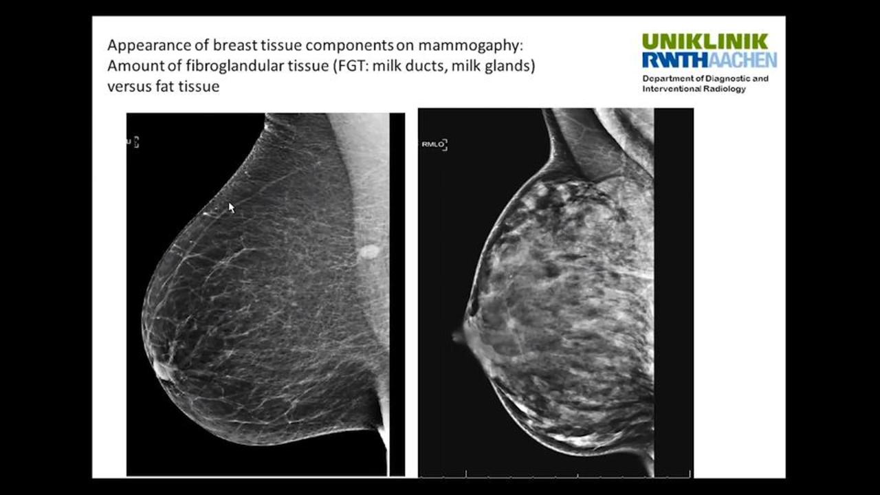 Video Explaining Dense Breasts Imaging Technology News