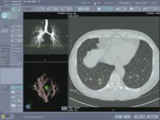 Is Lung Cancer Better Detected From An X Ray Or Ct Scan