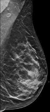 Breast Density Explained Imaging Technology News