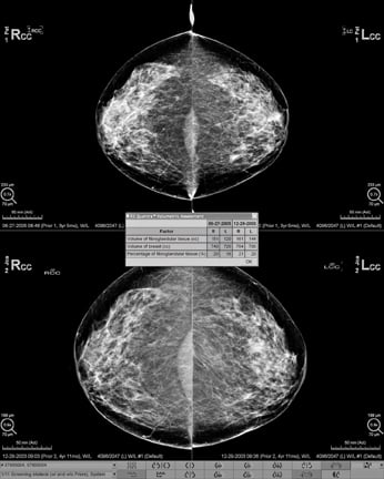 Fibroglandular Densities Mammographic Breast Density Itn