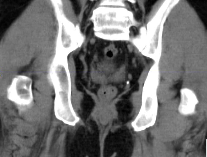 Radiation therapy clinical trial study pelvic cancer diarrhea sulfasalazine