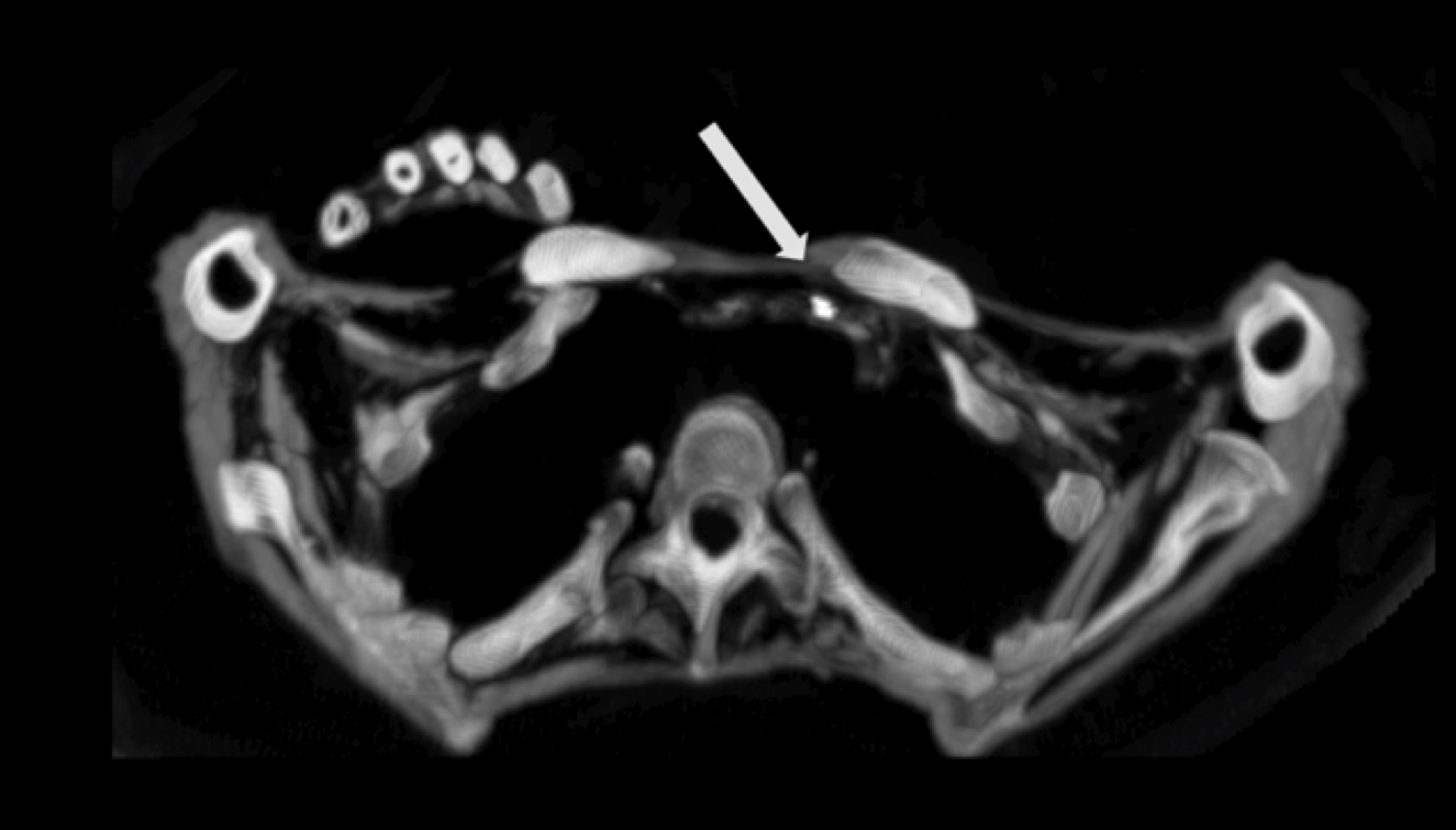 Mummy Ct Scans Show No Significant Differences In Atherosclerotic Disease In Modern Vs Ancient Egyptians Imaging Technology News