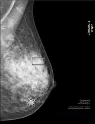 Fibroglandular Densities Mammographic Breast Density Itn