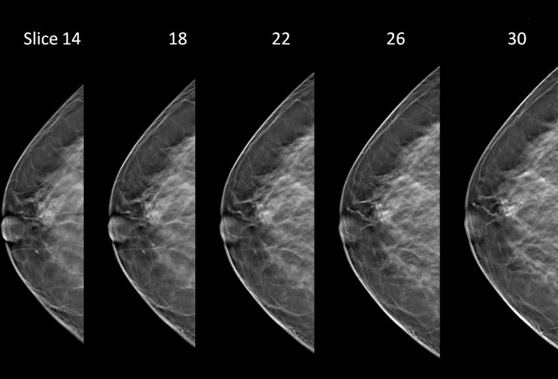 Hologic Showcases 3-D Mammography, Advanced Imaging Technologies at RSNA 2012