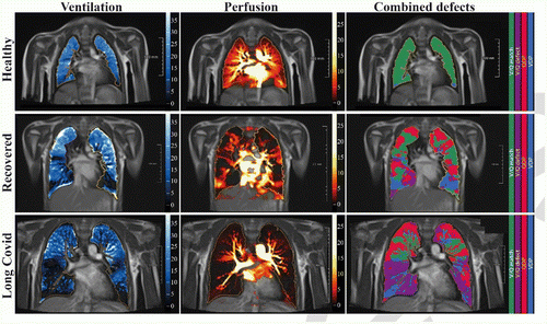 PHOTO GALLERY How COVID-19 Appears on Medical Imaging Imaging Technology News