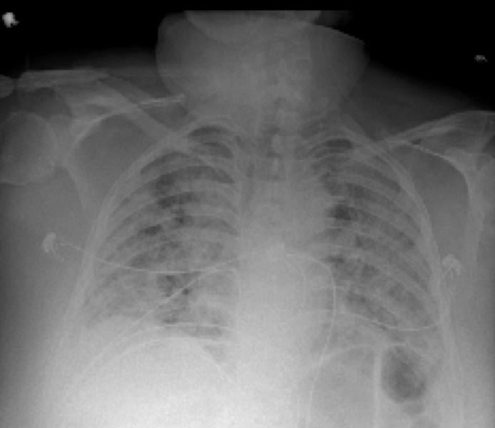 MIBE: RSNA Radiology Podcast - X-Ray Dark-Field Chest Imaging