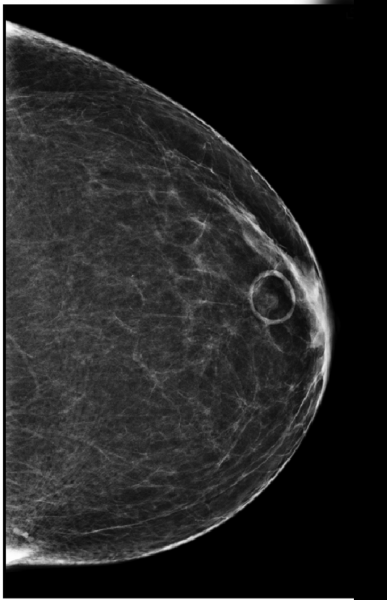 How Use of Mammography Skin Markers Improves Patient Perception of Care