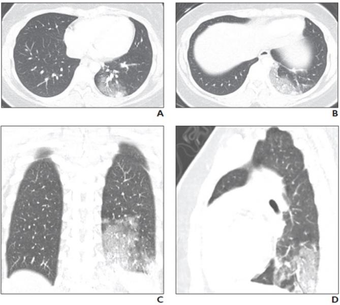 Download Covid 19 Pediatric Findings In New Review Of Lung Disorders Imaging Technology News