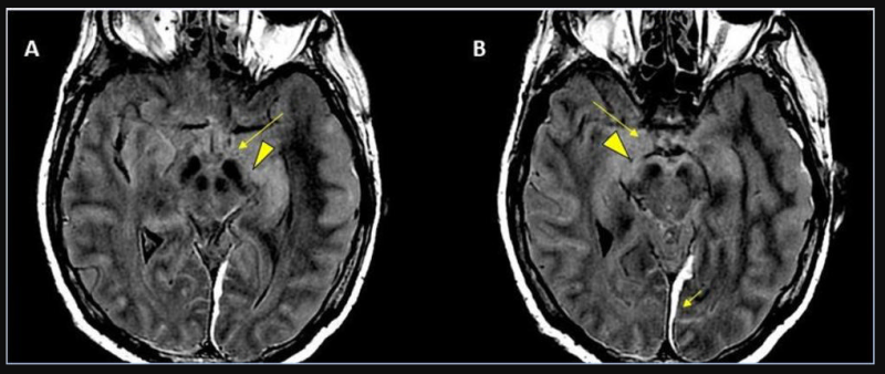 a) Four different LV plane positions during MRI, and (b) six