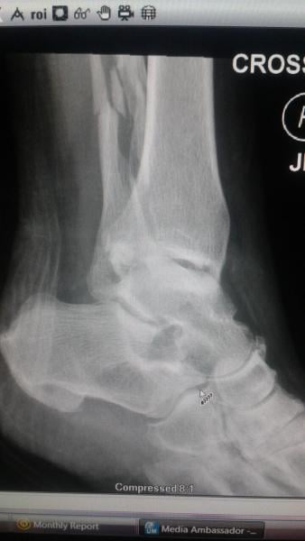 spiral fracture x ray