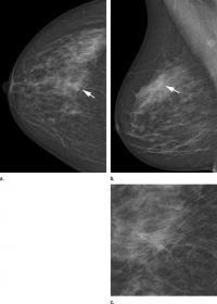 Mammography Systems Women's Health Clinical Study DR CR Radiation Dose