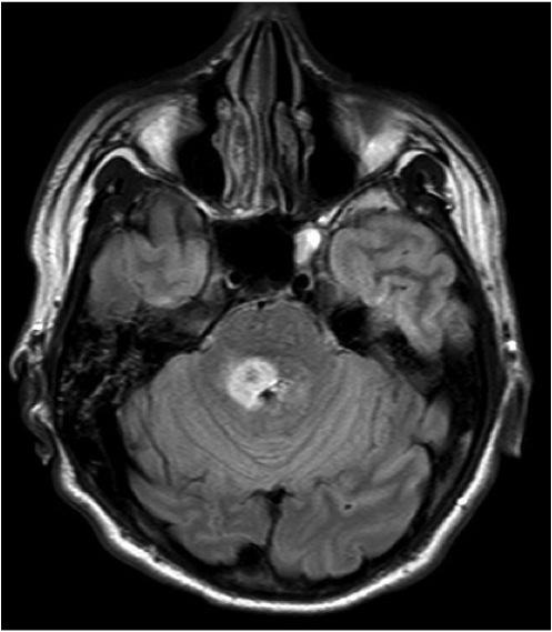 cerebral metastases, stereotactic radiosurgery, SRS, survival, AANS, Marshall