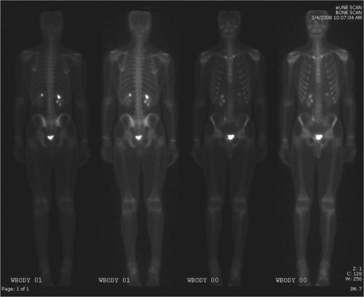 University of Manchester, PET, radiotherapy, cured patients, Hodgkin lymphoma