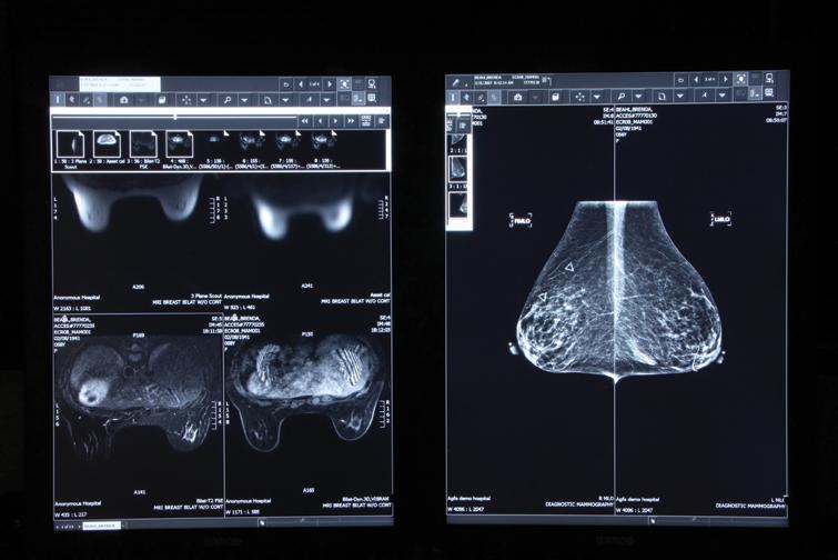 dense breast tissue