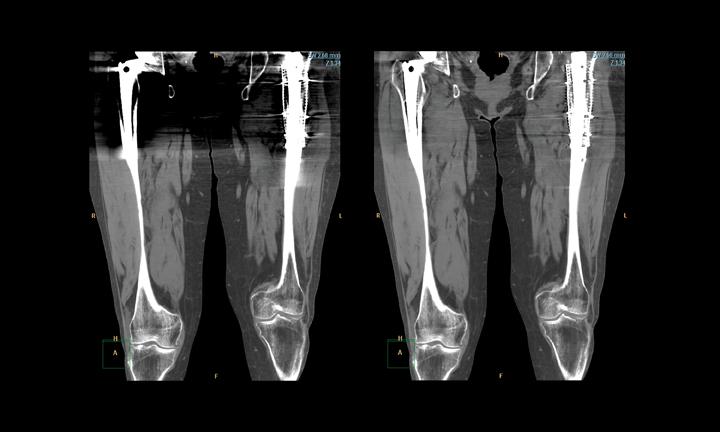 CT image iterative reconstruction iDose4 software from Philips showing improvement in image quality.