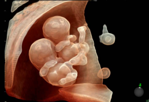 twins ultrasound 30 weeks