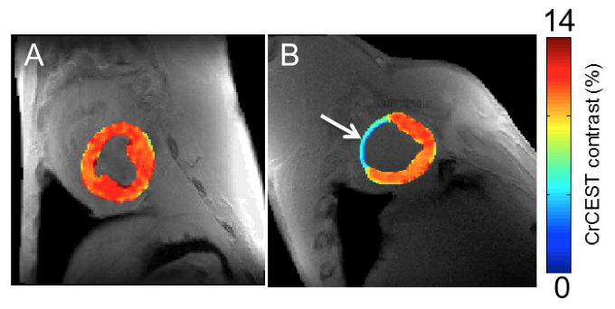 mri systems clinical trial study university pennsylvania creatine CEST map