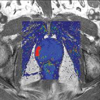 VividLook software helps spot cancer by imaging the speed of contrast flow into 