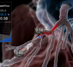 Four Blue Cross Blue Shield Companies Issue Positive Medical Policies on HeartFlow FFRct Analysis