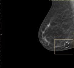 Half of all women experience false positive mammograms after 10