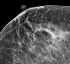 Breast Density Inform Bill Mammography Systems Women's Healthcare